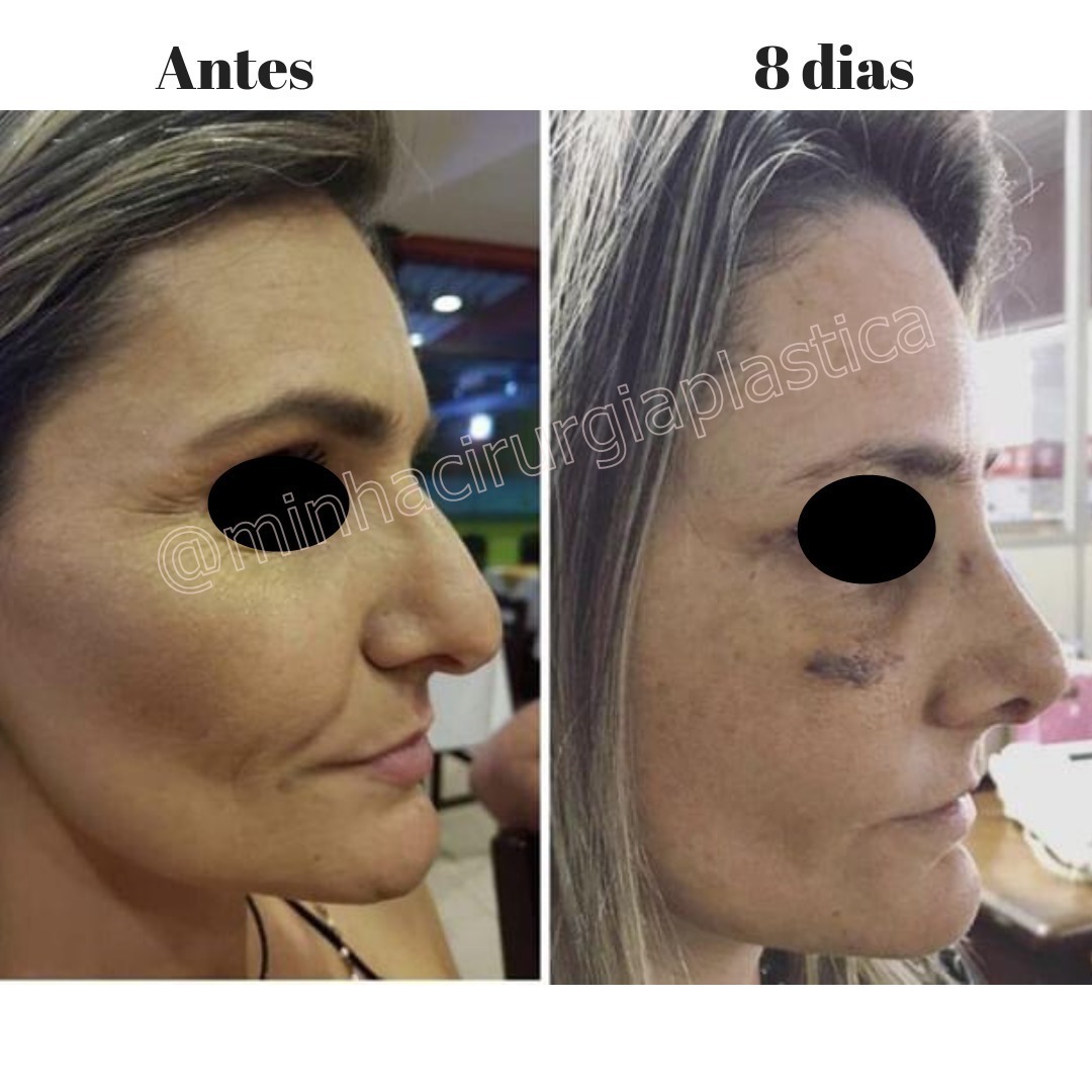 Rinoplastia - Cirurgião Dr. Marcelo Mariottini, Araraquara/SP