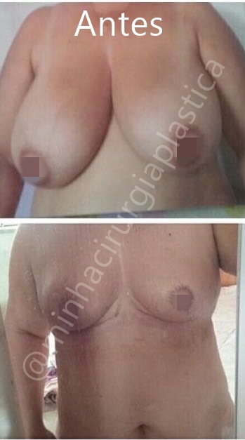 Redução de mamas sem proteses