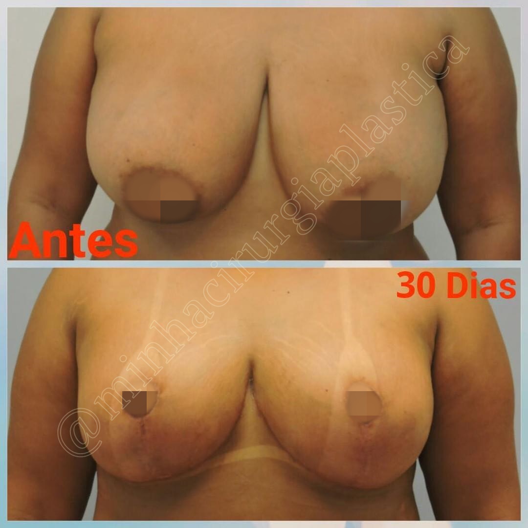 Redução de mamas sem próteses e lipo tórax lateral