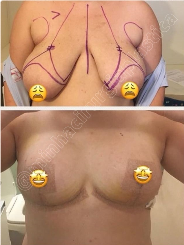 Redução de mamas ( sem prótese) e lipo de axilas