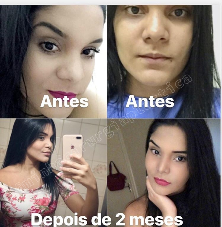 Ooforoplastia em Foz do Iguaçu