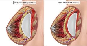 Uma das principais dúvidas é referente à colocação do implante em plano submuscular ou subglandular.