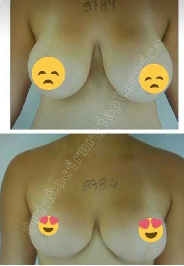 Redução de mamas sem proteses