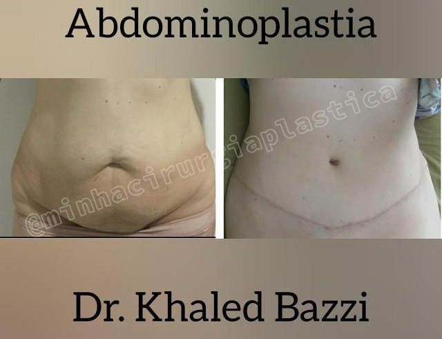 Abdominoplastia estendida (flancos)