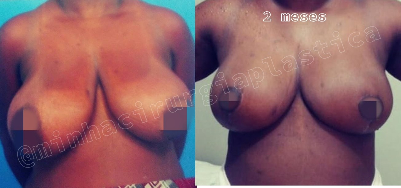 Redução de mamas sem prótese(SUS)