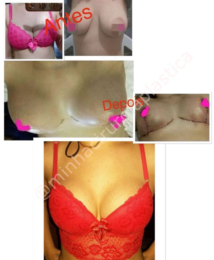 Redução de mamas com Prótese de silicone 235ml Mentor