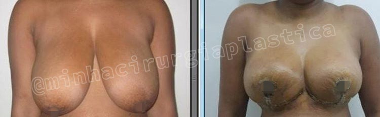 Redução de mamas sem prótese