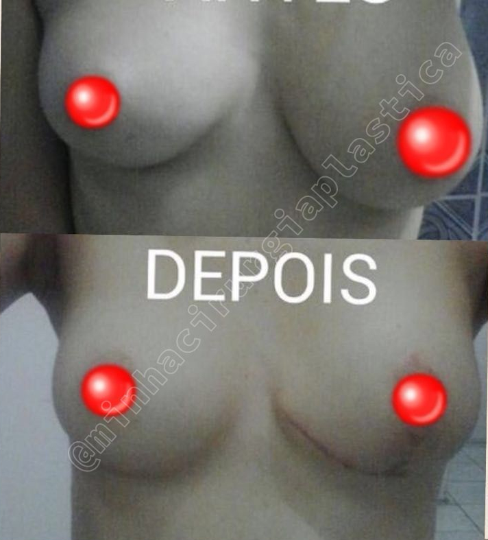 Redução de mama assimetria(SUS)