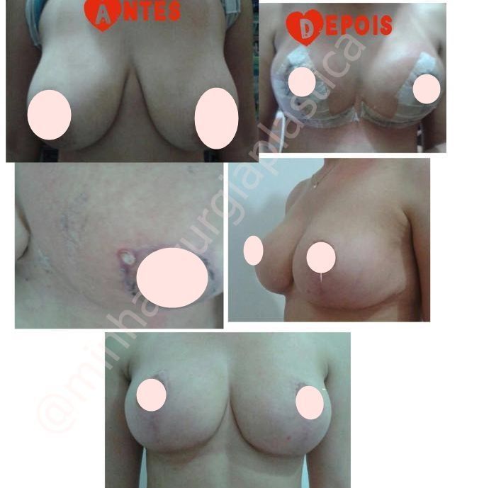 Redução de mamas  sem prótese(SUS) ⠀