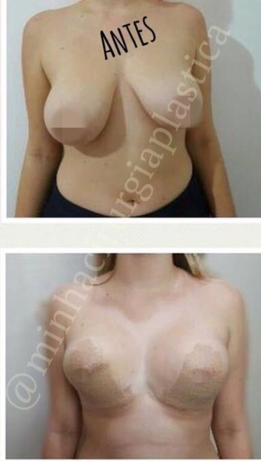 Redução de mamas sem próteses