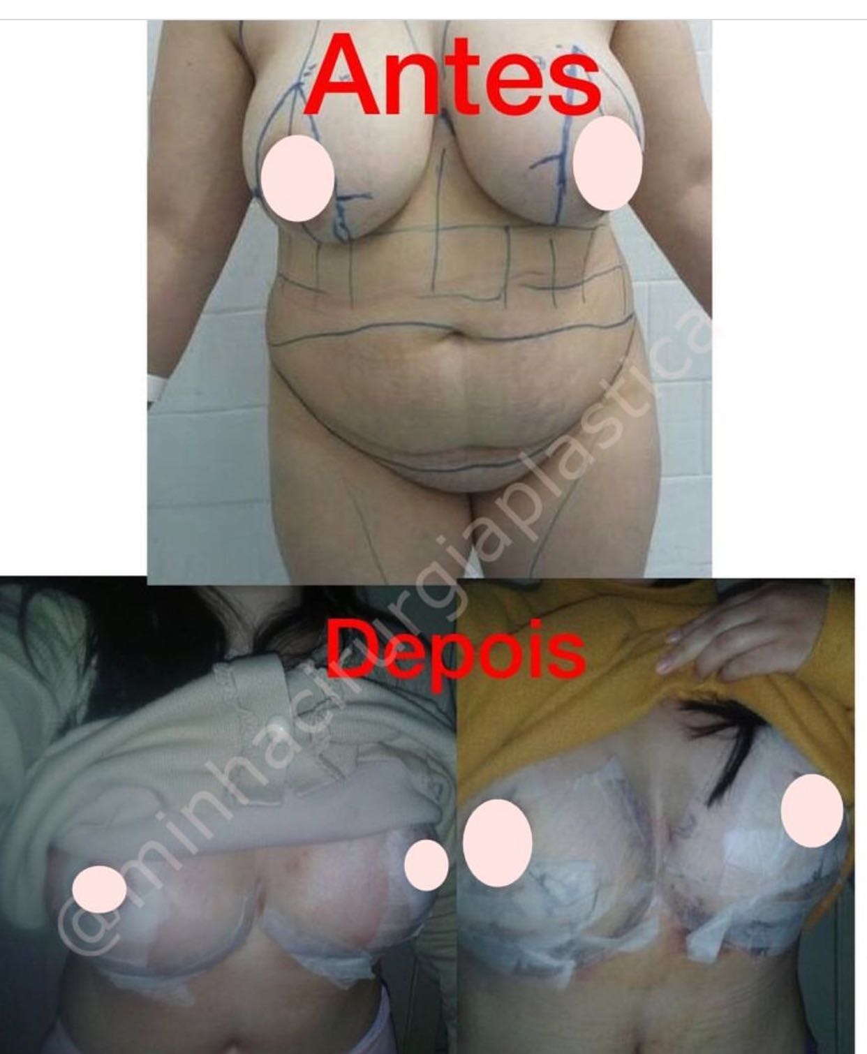 Lipo, abdominoplastia e Mastopexia com Prótese de silicone 325 ml Refinex