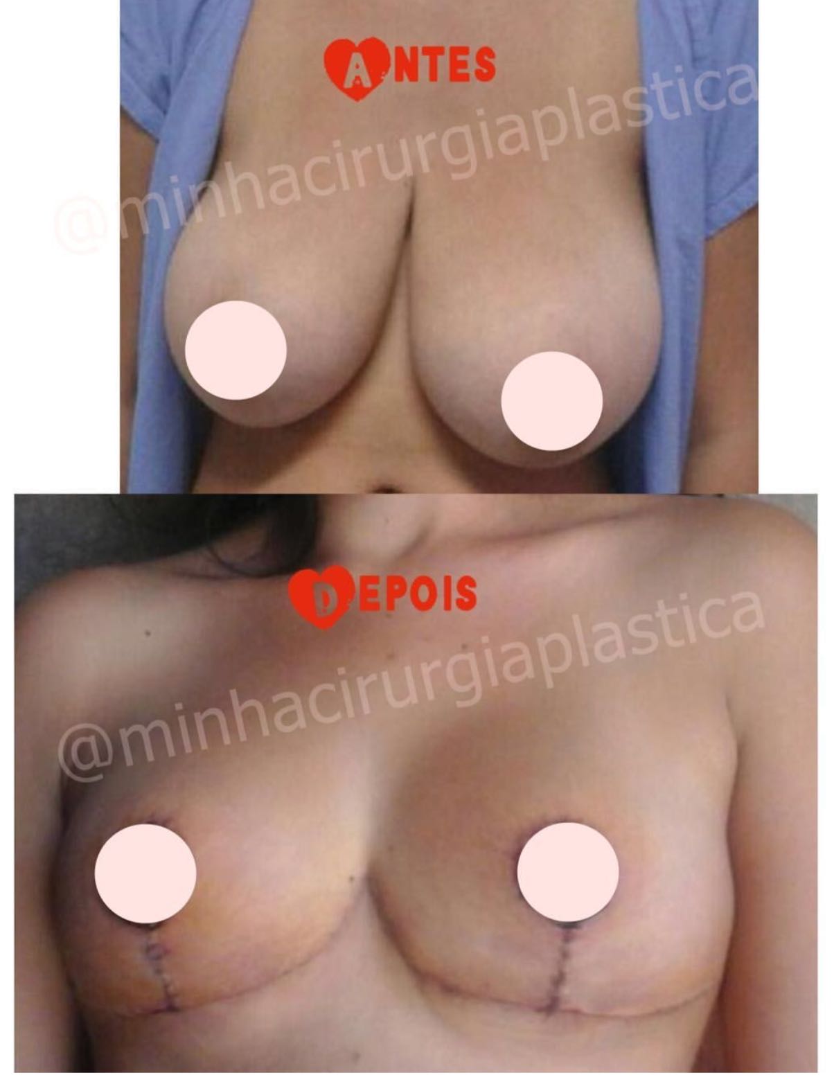 Redução de mamas sem próteses( SUS)