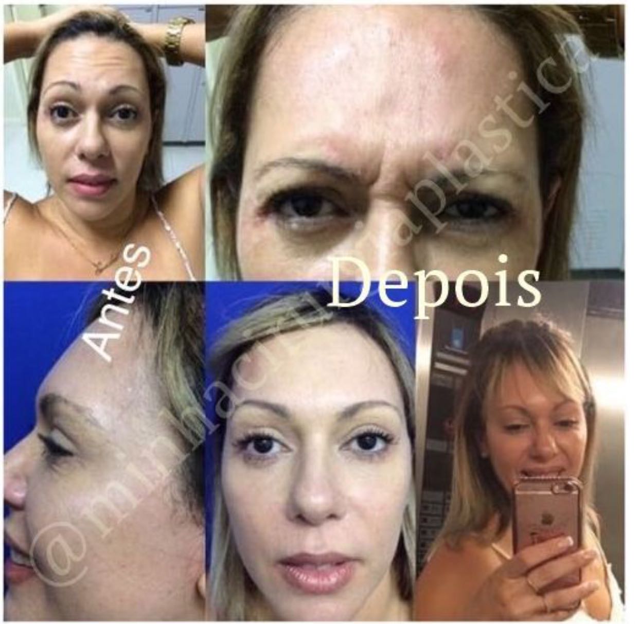 Rejuvenescimento facial com Botox