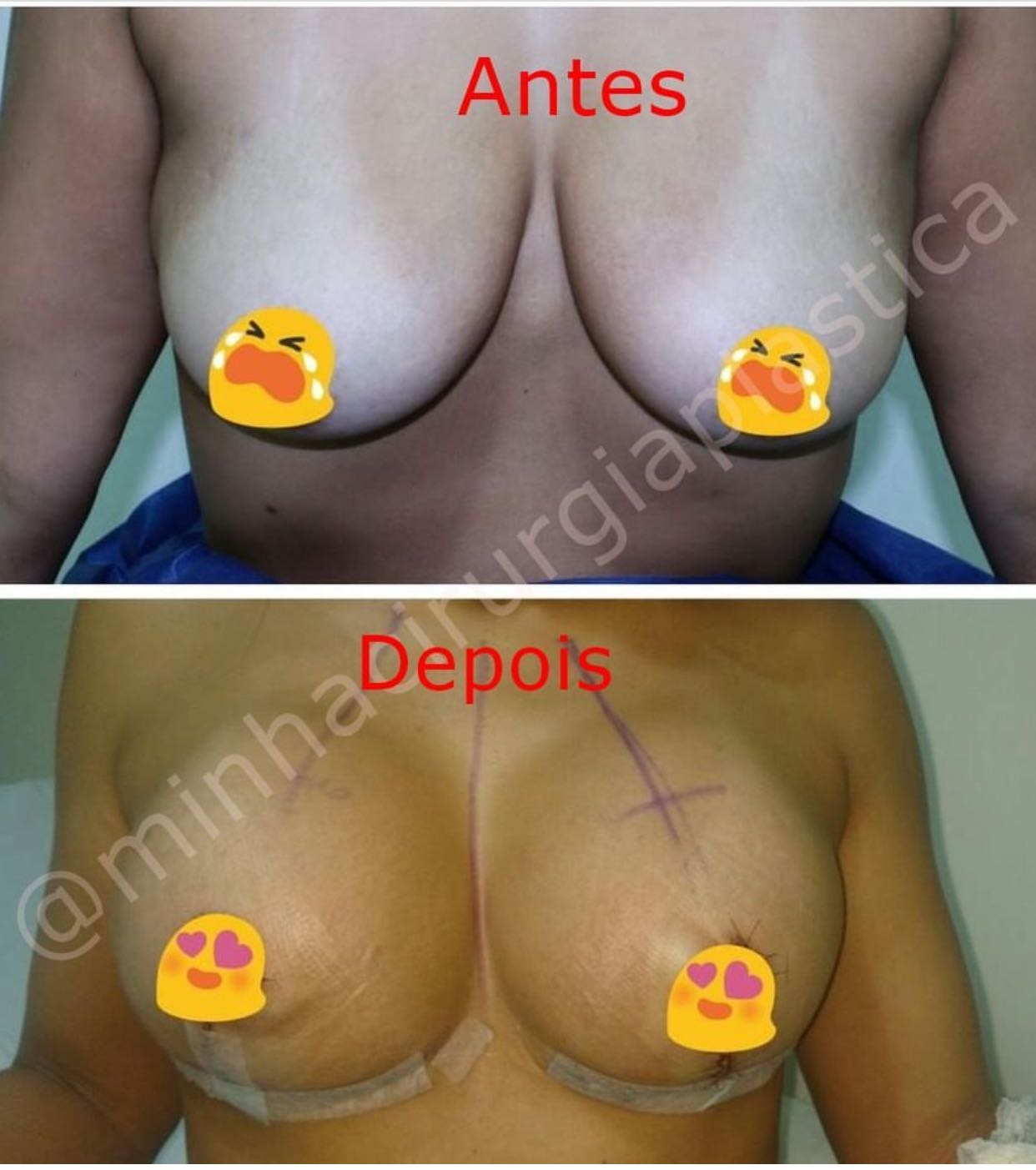 Redução de mamas com prótese silicone 260 ml Mentor⠀