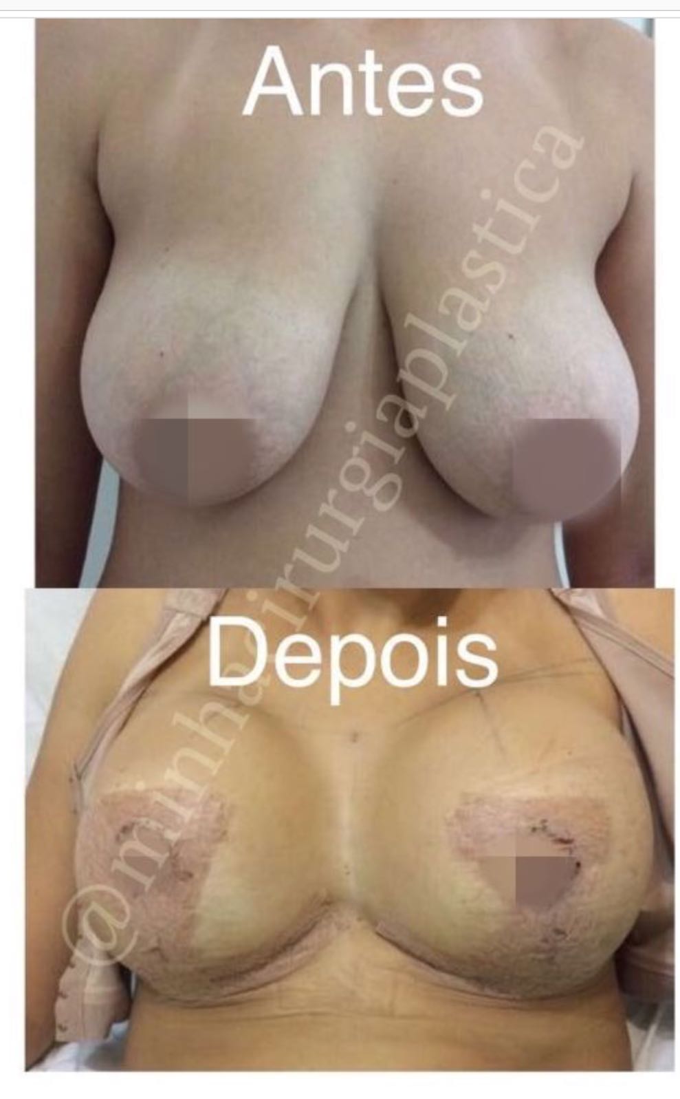 Redução de mamas com Prótese de silicone 350ml Lifesil