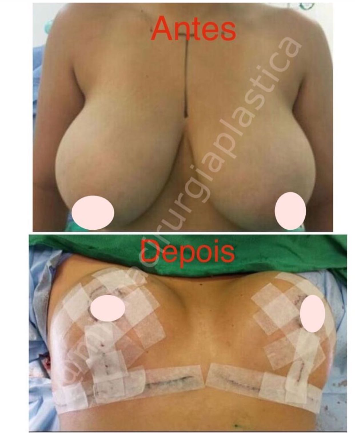 Redução de mamas  sem prótese