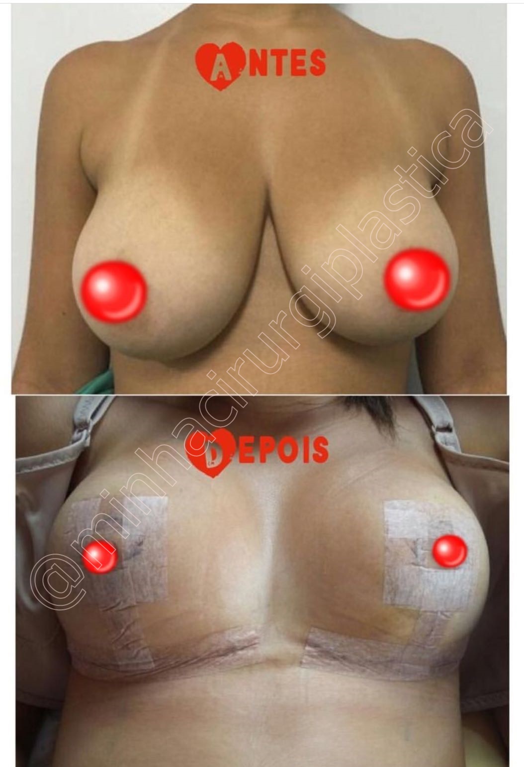 Redução de mamas sem prótese ⠀