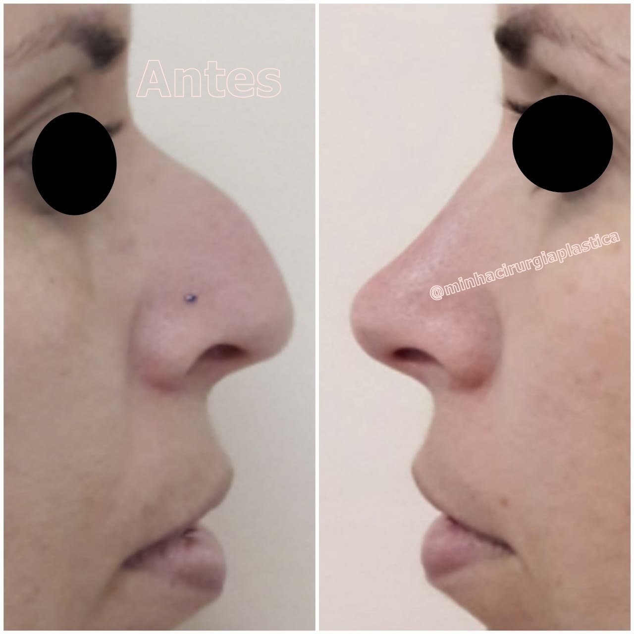 Rinoplastia (+preenchimento de bigode chinês e laser para tirar manchas)