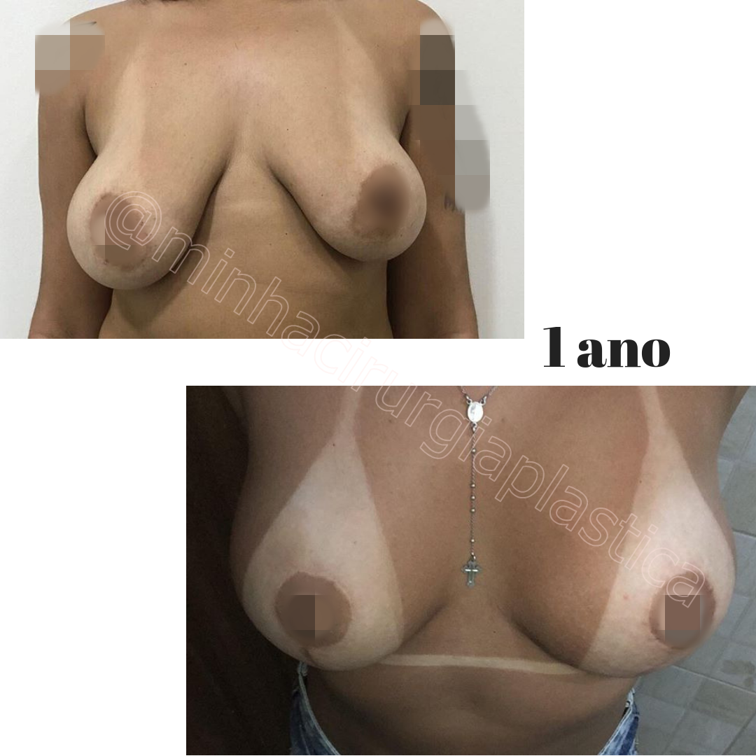 Mastoplastia com prótese de silicone 175ml (Reconstrução da mama)