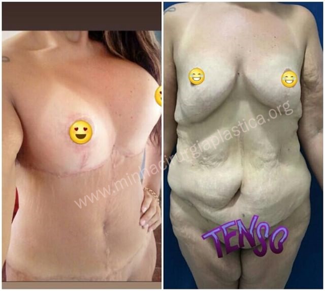 Abdominoplastia em ancora , torsoplastia + Mastopexia com prótese de silicone 500ml em