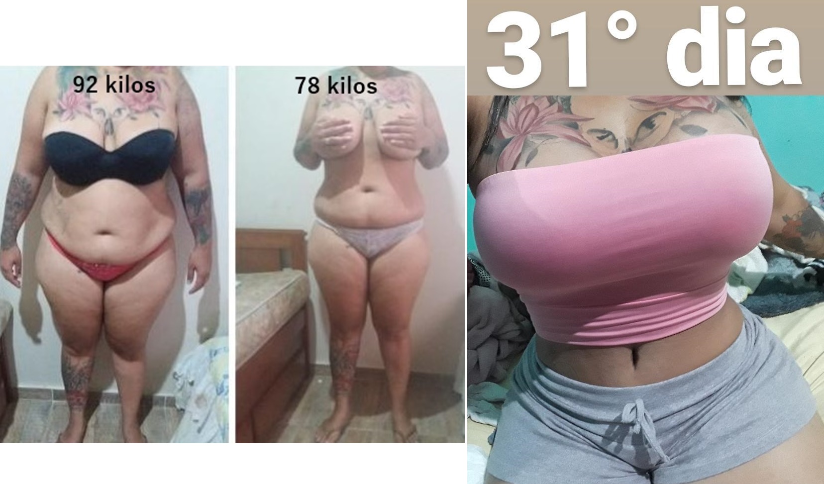 Abdominoplastia + lipoescultura mastopexia com prótese 400ml