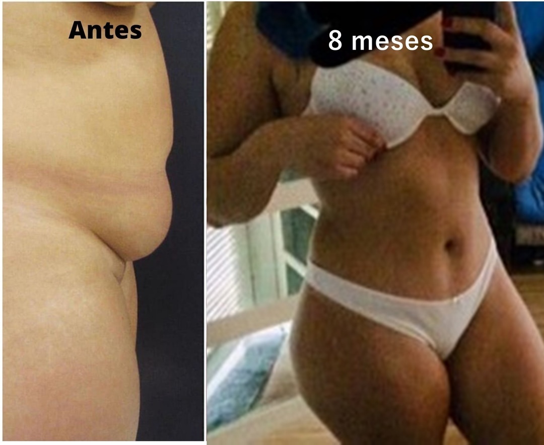 Abdominoplastia sem lipo