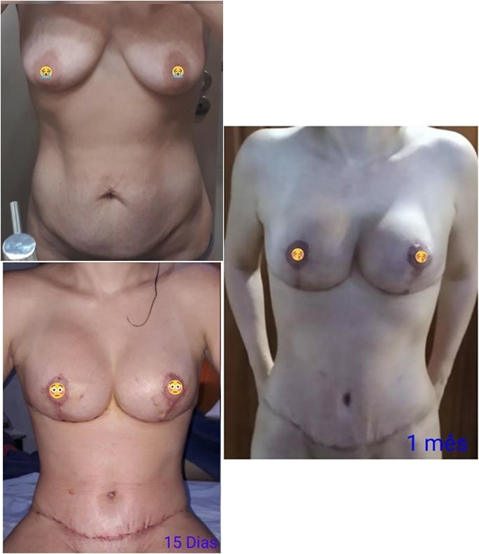 Abdominoplastia SEM LIPO + Mastopexia com prótese de silicone 250ml