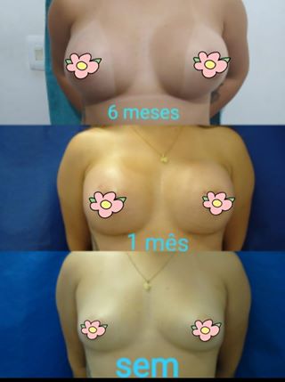 Próteses de silicone 330ml silimed (Correção mama Tuberosa)