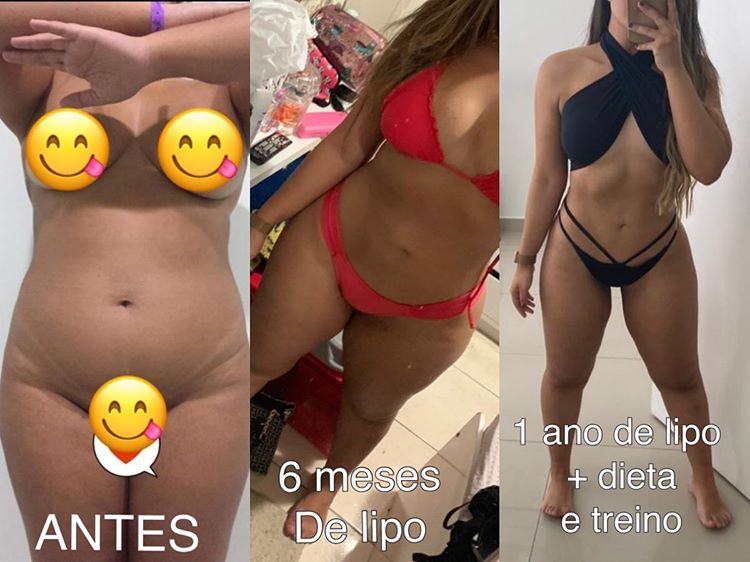 Lipo