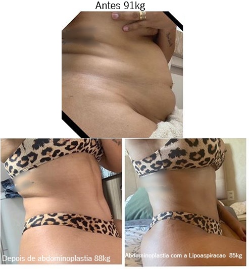 Abdominoplastia e Lipoescultura