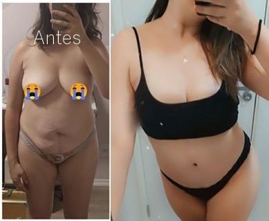 Abdominoplastia e Mastopexia com Protese de 335ml Silimed