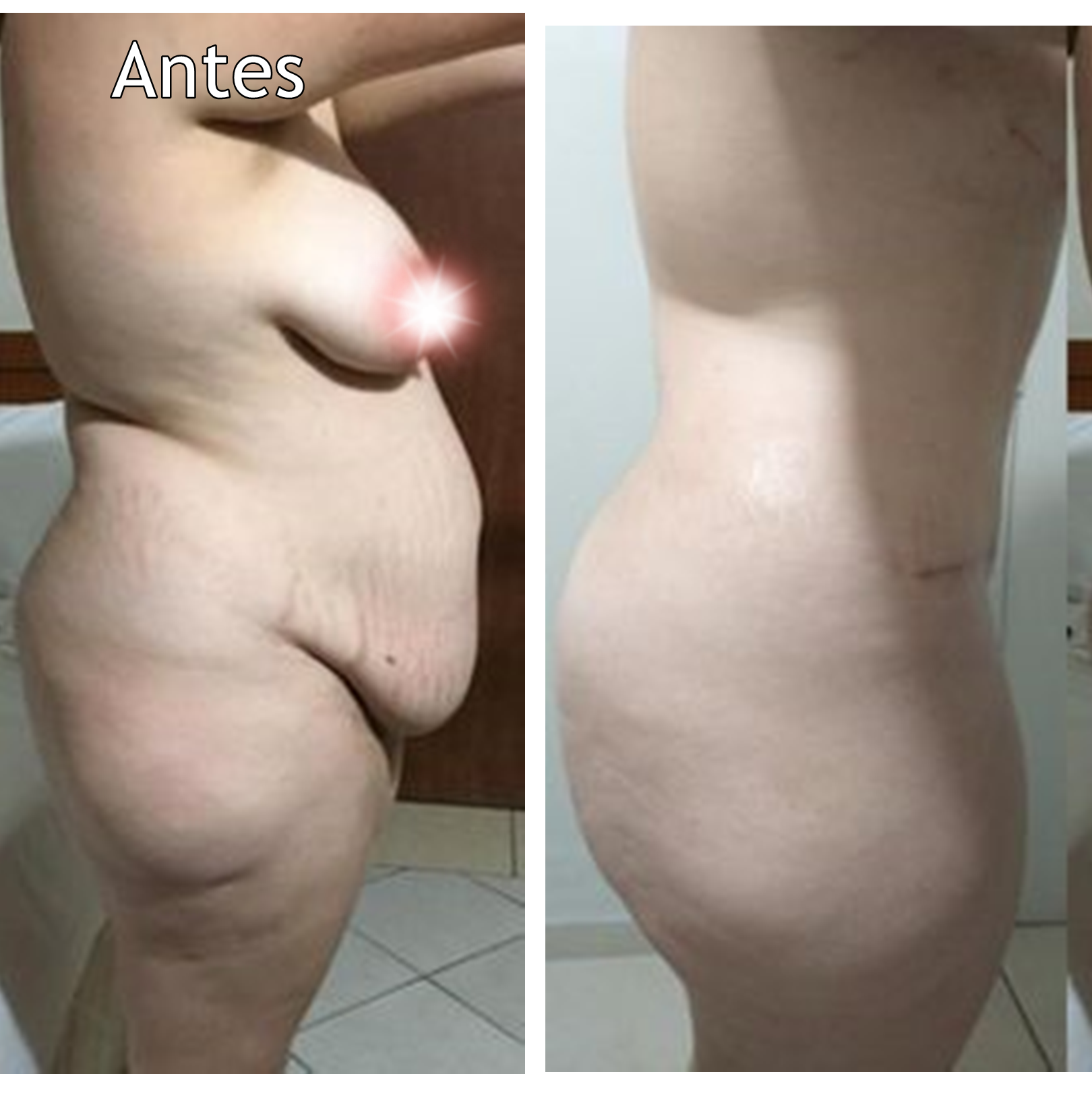 Abdominoplastia , lipo e Redução de mamas com protases 185ml
