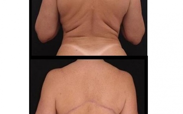 Abdominoplastia superior e torsoplastia