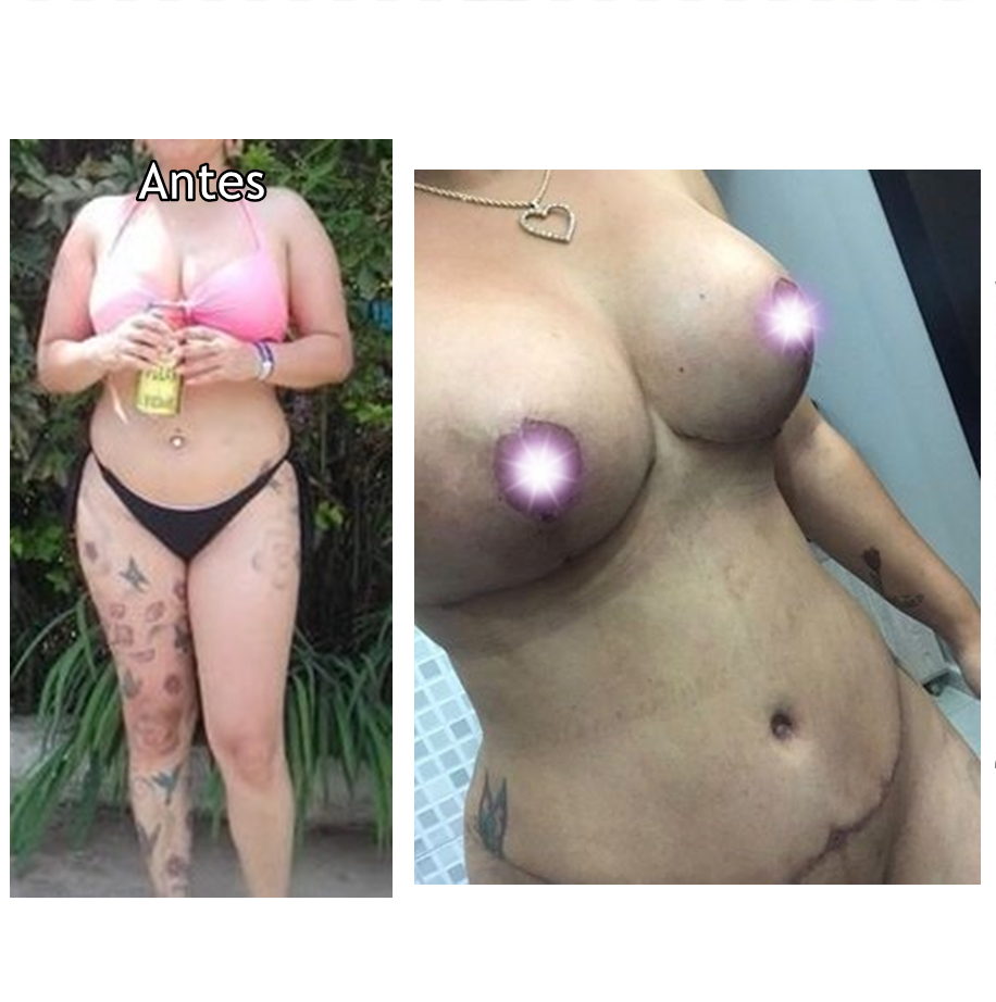 Abdominoplastia, Lipo e Redução de mama com próteses de silicone de 245ml