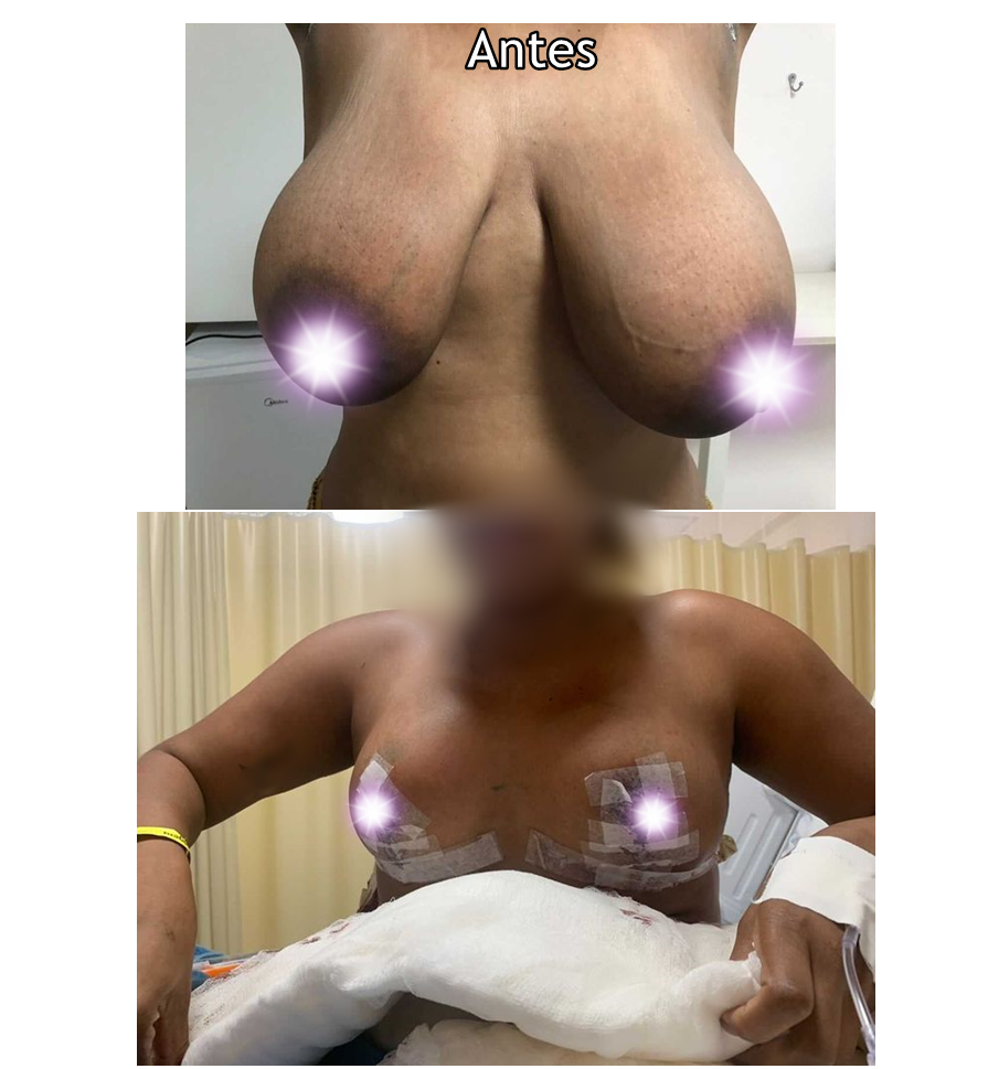 Redução de mamas sem prótese