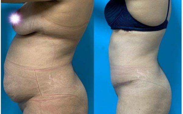 Abdominoplastia sem lipo (SUS)