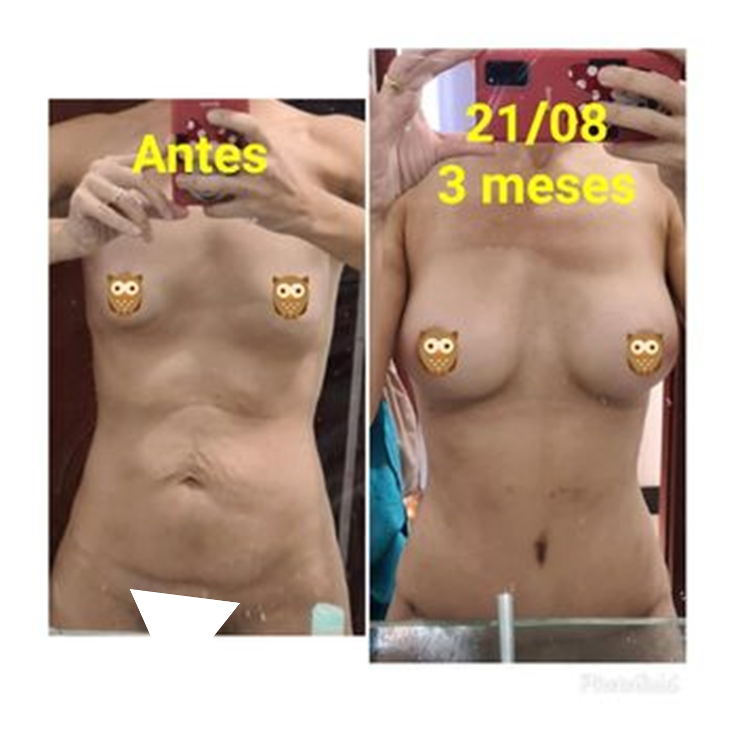 Abdominoplastia e Proteses de silicone 350ml Mentor