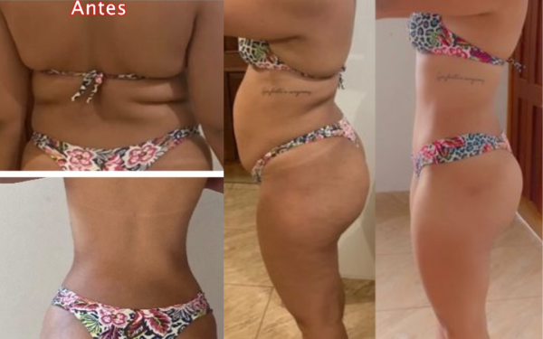 Abdominoplastia , lipoaspiração nas costas e laqueadura