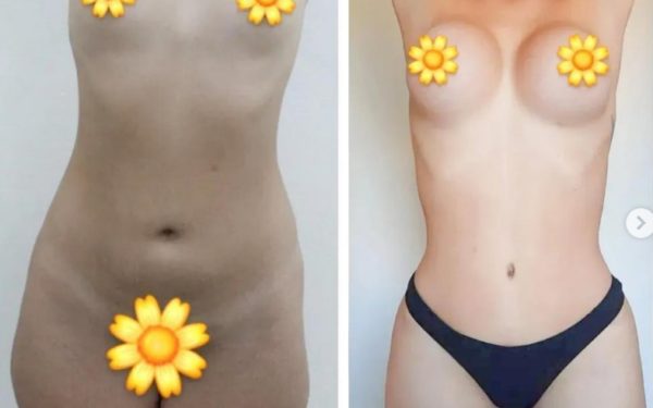 Lipoescultura, abdominoplastia e Próteses de silicone 390ml silimed