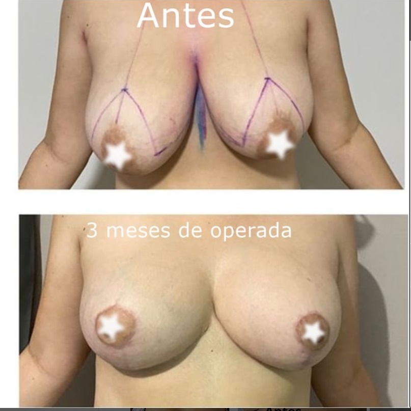 Redução de mama sem prótese